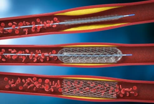 Cardiology Interventional Procedures